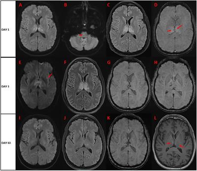 Case Report: Acute Necrotizing Encephalopathy Following COVID-19 Vaccine